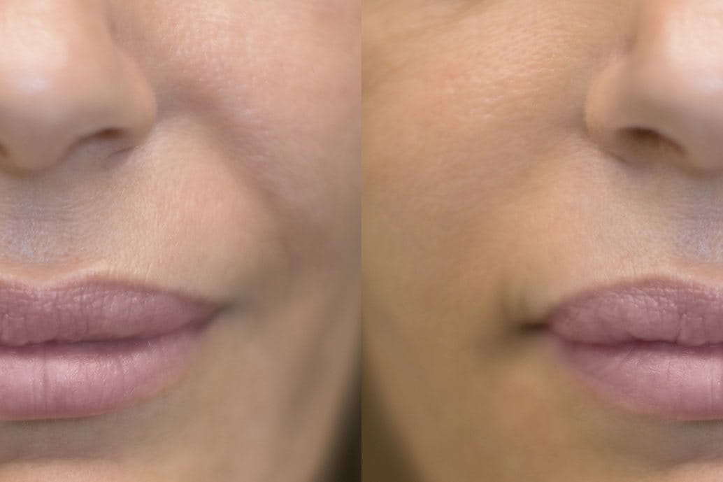 Rughe Della Marionetta Prima E Dopo Rughe Della Marionetta Prima E Dopo